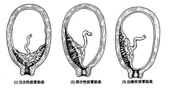 前壁胎盘≠前置胎盘,孕妈要注意区分!