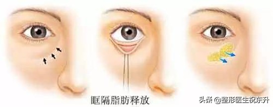 去眼袋做不做眶隔脂肪释放,眶隔脂肪释放和内切去眼袋过程