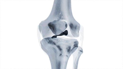 走路膝盖会突然软一下就骨折,走路时膝盖突然软一下怎么治