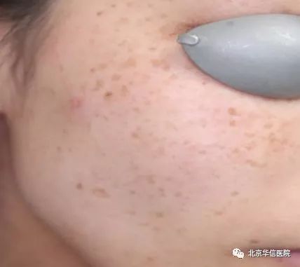 光子嫩肤帮你逆袭光滑细嫩状态,光子嫩肤让你拥有蛋壳般肌肤