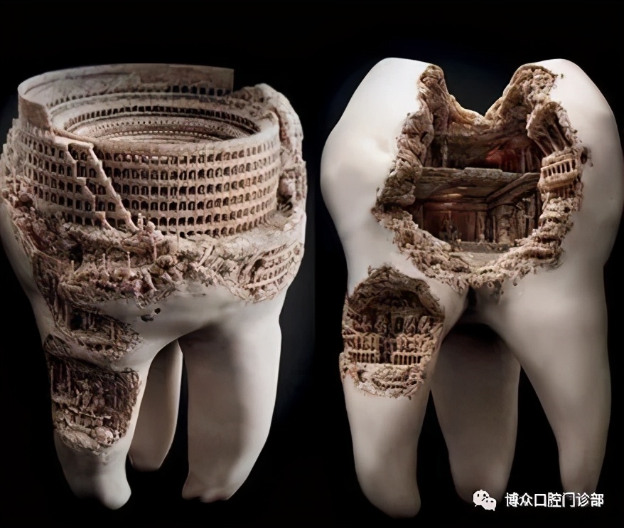 长蛀牙不是小朋友的标配,蛀牙每个人都有吗