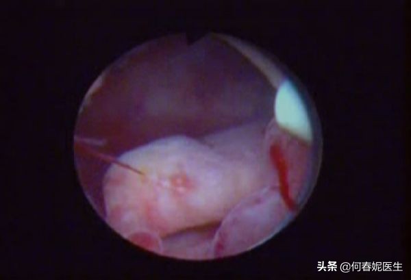 曼月乐能治疗妇科炎症吗,曼月乐有避孕效果吗