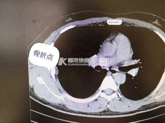 30岁男子咳嗽咳断2根肋骨医生提醒,年轻男子咳嗽把自己肋骨咳断