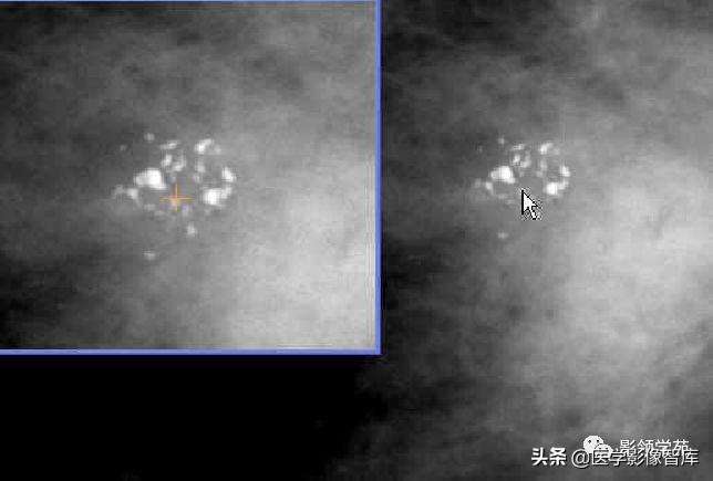 乳腺钙化怎么区分良性和恶性,乳腺钙化的诊断与分级