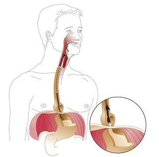 为什么吃奥美拉唑肠溶胶囊没用,为什么说奥美拉唑不能长吃