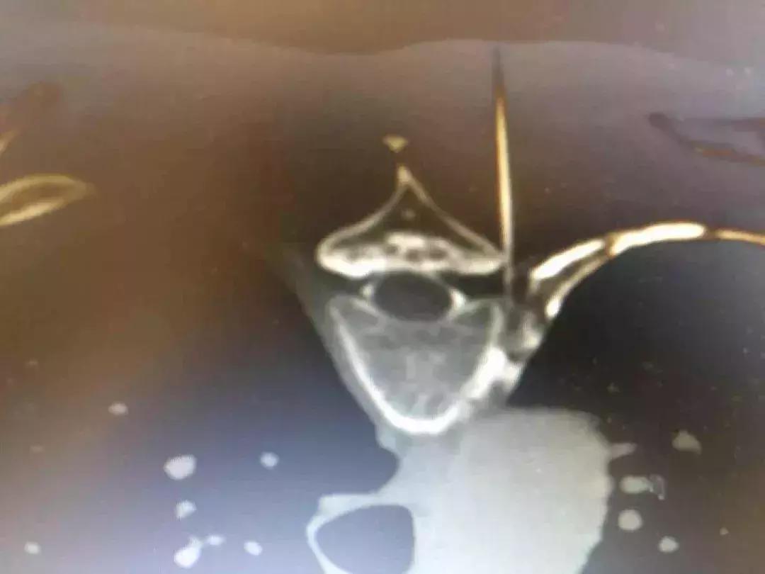 “倚天佑铂桐屠龙”——缠腰龙老人的疼痛终结史