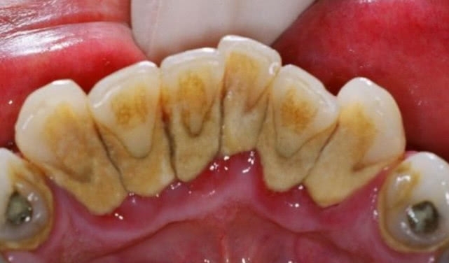 用手抠掉黑色的牙结石,有啥办法能抠掉牙结石