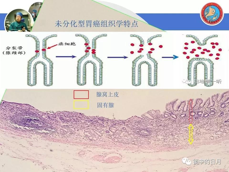 低分化胃癌早期时候做内镜手术吗,早期胃癌内镜手术后追加外科手术