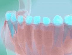 如何预防宝宝的双排牙,换牙出现双排牙不齐怎么办