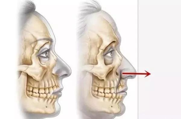 脸垮法令纹深最省钱的办法,脸垮了法令纹该怎么办