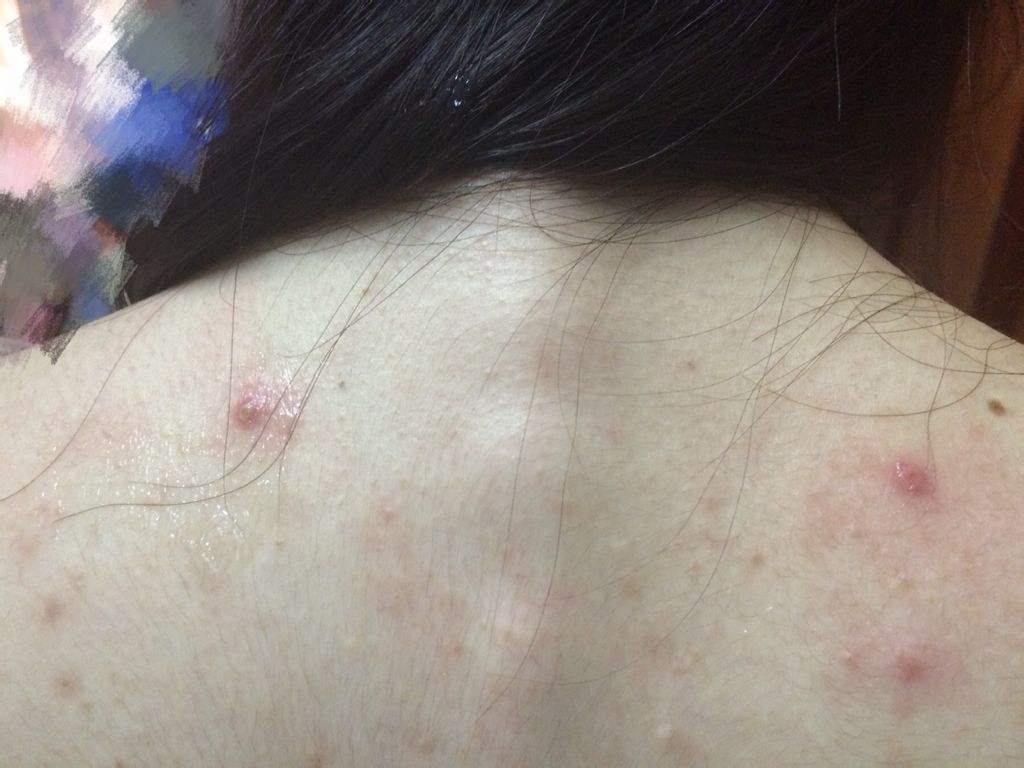 前胸后背长螨虫的原因和解决方法,胸前后背螨虫痘痘去除方法