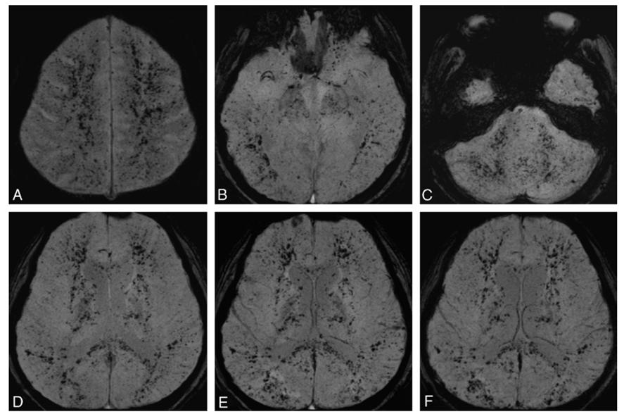 头疼做磁共振脑小血管有点出血,核磁共振说脑血管出血
