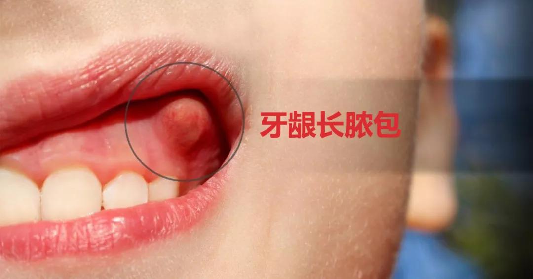 孩子牙龈肿了一个脓包要怎么处理,儿童牙龈长脓包怎么消除最快方法