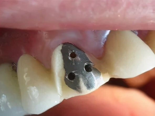 烤瓷牙基底冠如何清洁不崩瓷,烤瓷牙咬合面崩瓷必须重做吗