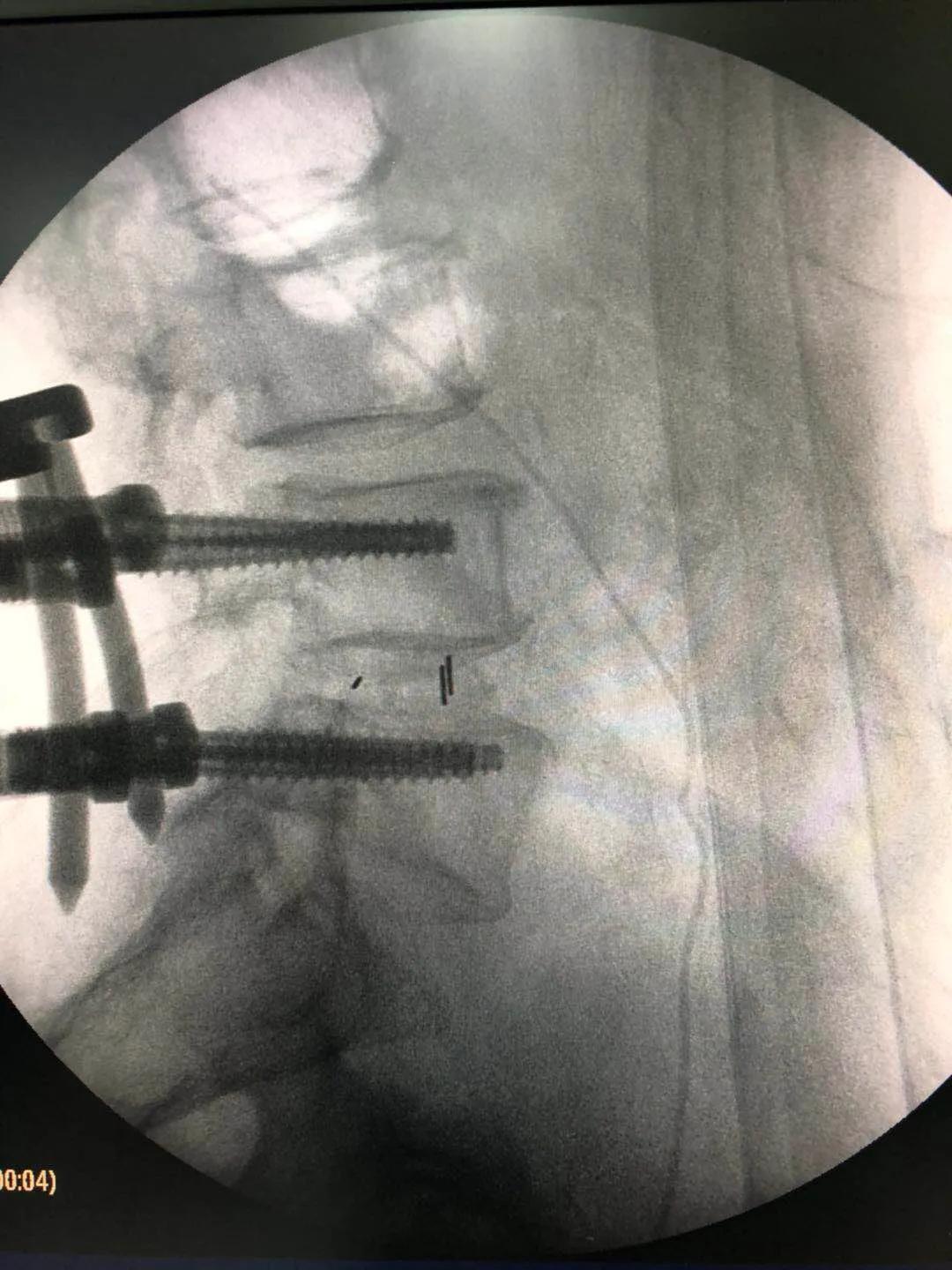 南通首例！海安市中医院骨伤科成功开展UBE技术治疗腰腿痛