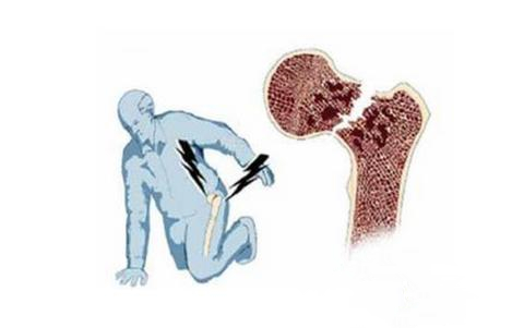 老年人腿粉碎性骨折手术要多少钱,老年人髋骨骨折后一年死亡率
