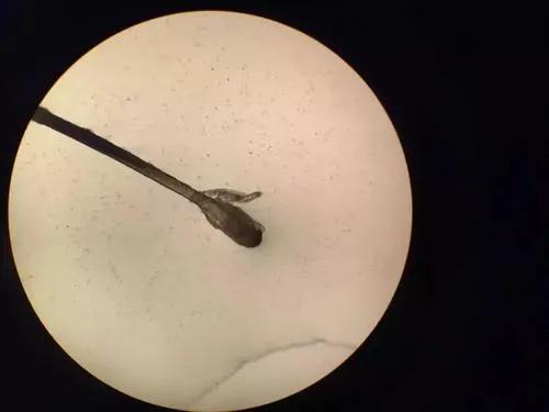 眼里有虫子应该怎么办,眼里有虫子需要马上治疗吗