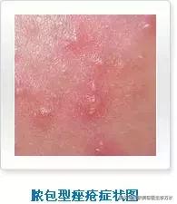 痘痘十大真相,痘痘大全图解