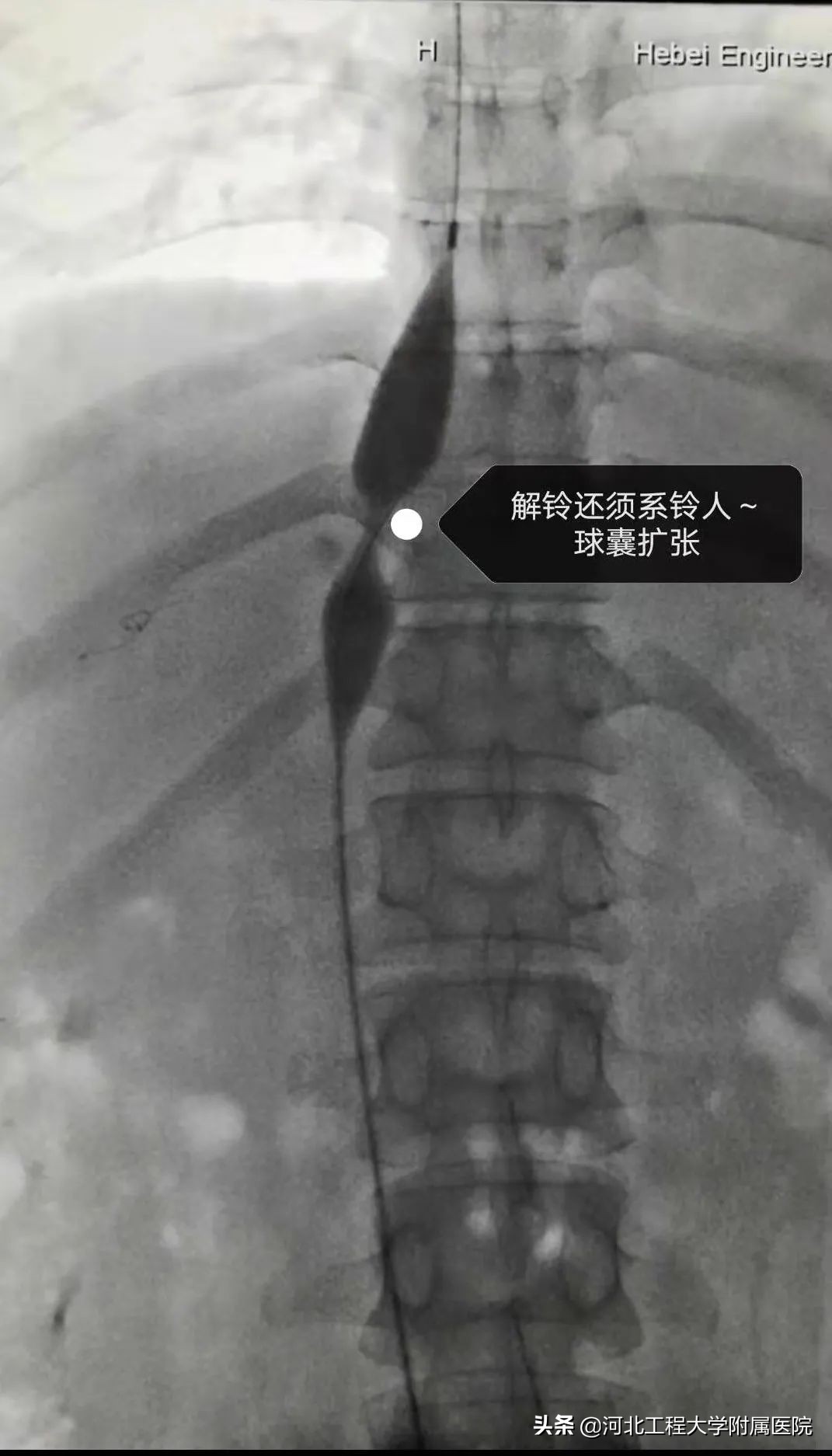 河北工程大学附属医院多学科诊疗,河北省布加氏综合征