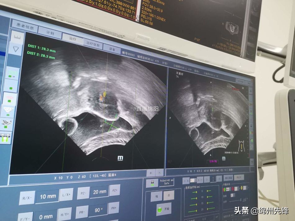 超声波精准治疗癌症,绵阳最有效的黑科技