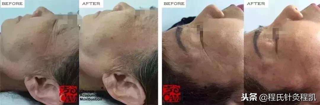 最新不踩坑的脸部美容项目方法,最新日本美容项目提拉方法