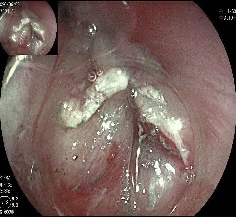 贲门处见隆起性病变,贲门高级别瘤变esd术后不能吃什么