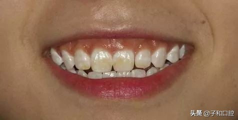 一口黄牙有多尴尬,一口烂牙怎么补救