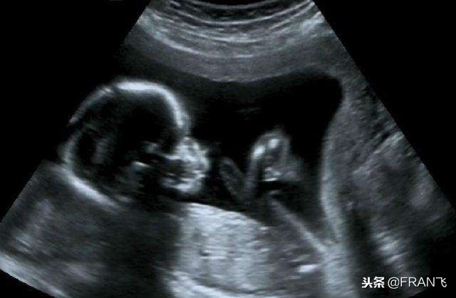 这三种情况下就别考虑生二胎了,出现这三种情况的孩子不能要