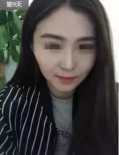 解密瘦脸针的几大常识性问题,关于瘦脸针的真实事件