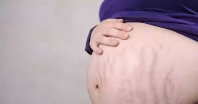 妊娠纹出现的前兆和过程,妊娠纹的前兆是什么