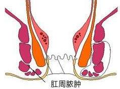 肛周脓肿怎么引起的医生知道吗,有比肛周脓肿更遭罪的病吗