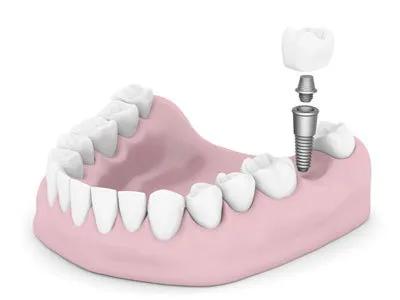 种牙怎么选专业医生,老牌种牙