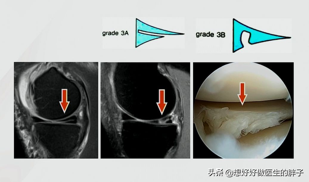 为什么足球运动员不会半月板受伤,足球运动半月板损伤