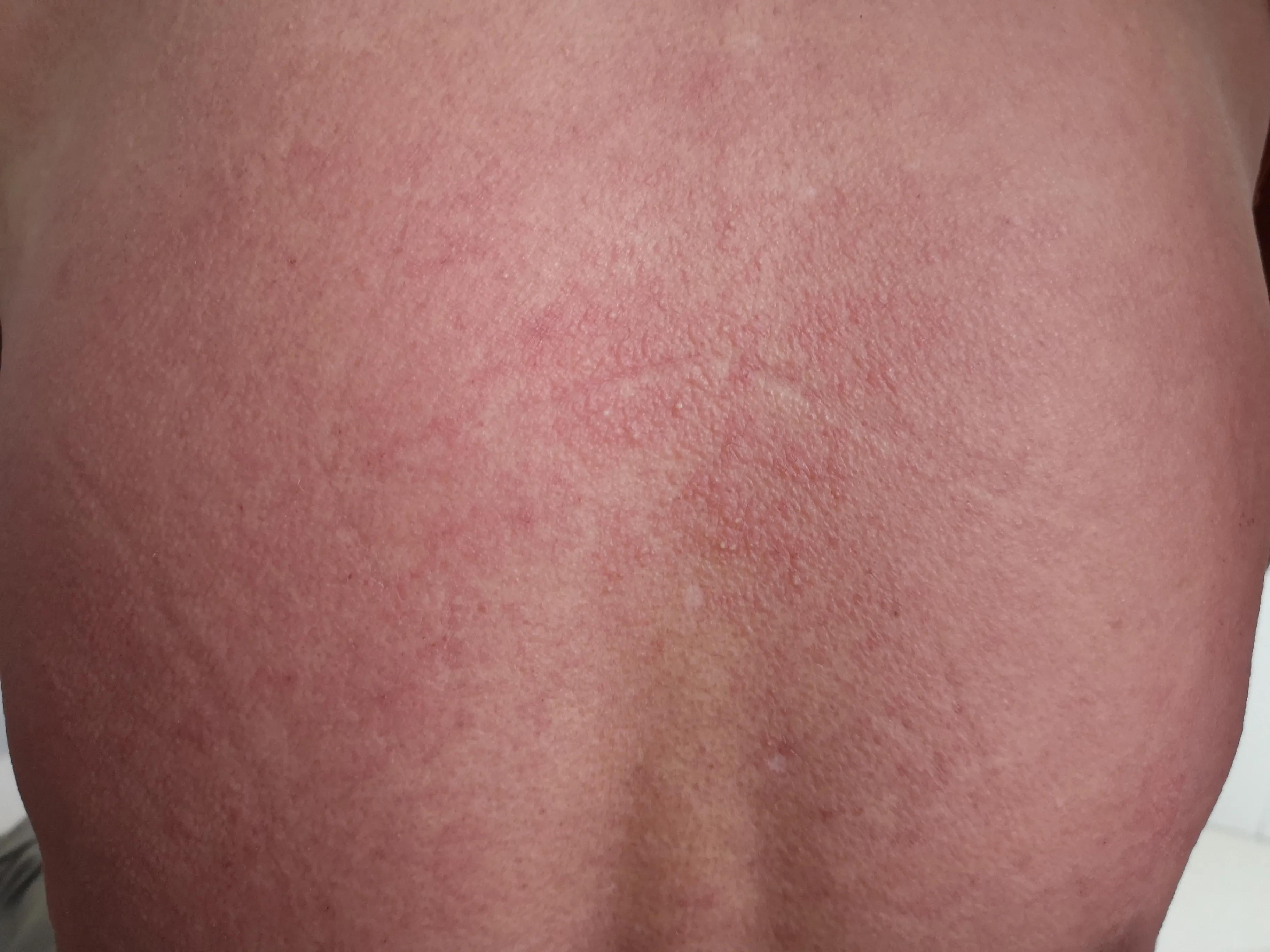 做了皮试但依然过敏死亡,皮试阴性一定是不过敏吗