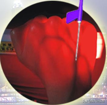 打静脉针,静脉扎针不回血是怎么回事