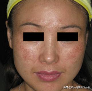 大面积褐青斑怎么治,有什么好方法淡黄褐斑