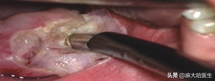 小孩扁桃体切除疼不疼,扁桃体切除术后疼不疼