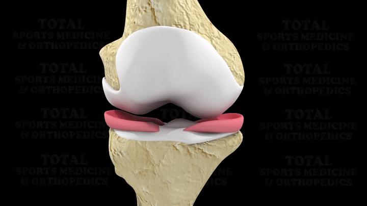 足球运动员为什么没有半月板,足球到底伤半月板吗