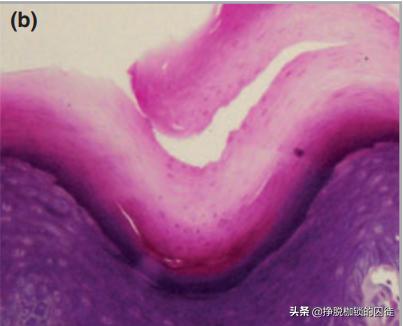 手每年春天手掌脱皮是什么原因,每年初夏手就开始脱皮