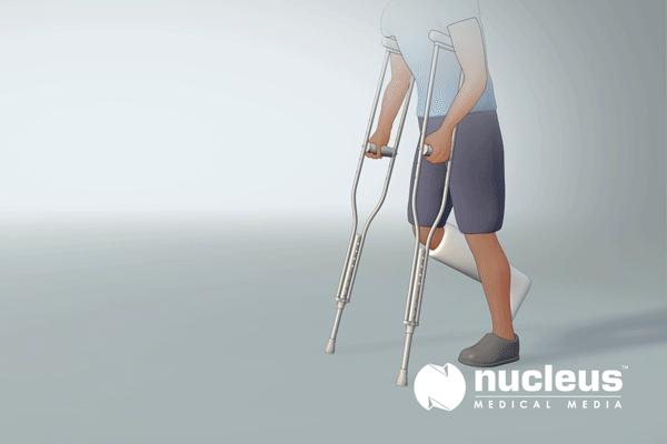 踝关节扭伤后期僵硬怎样康复治疗,踝关节肿胀期间必须要卧床抬高吗