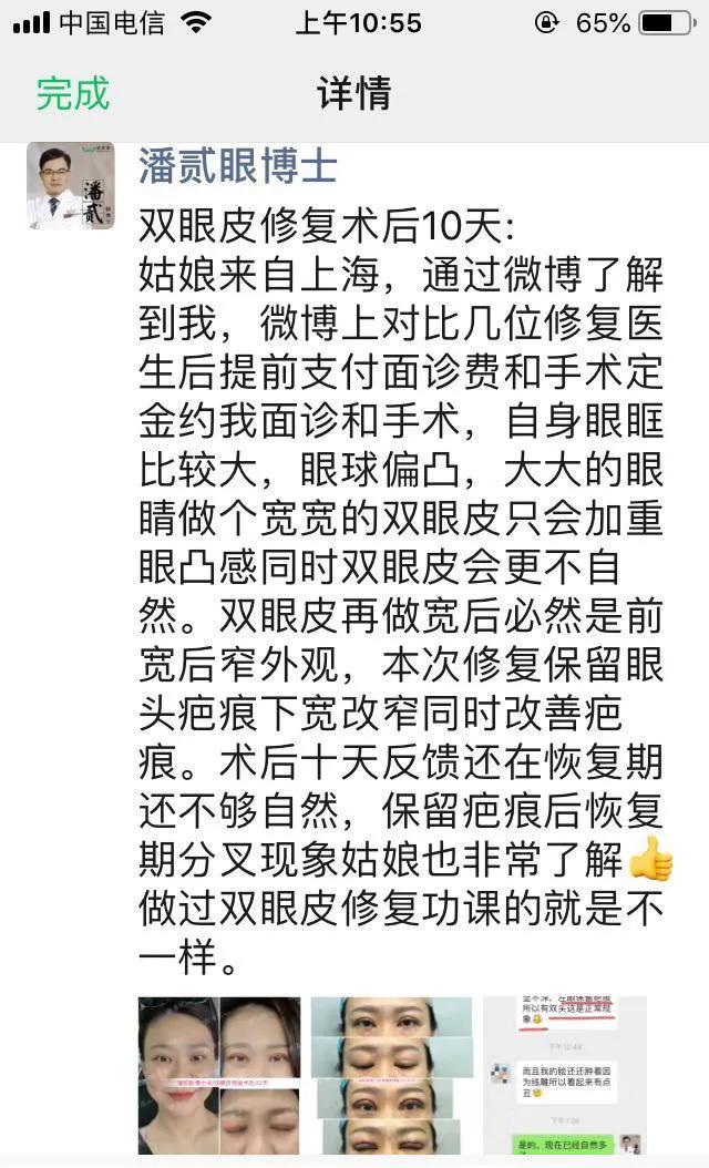 双眼皮修复改扇形双眼皮,平行双眼皮能改成开扇形双眼皮吗