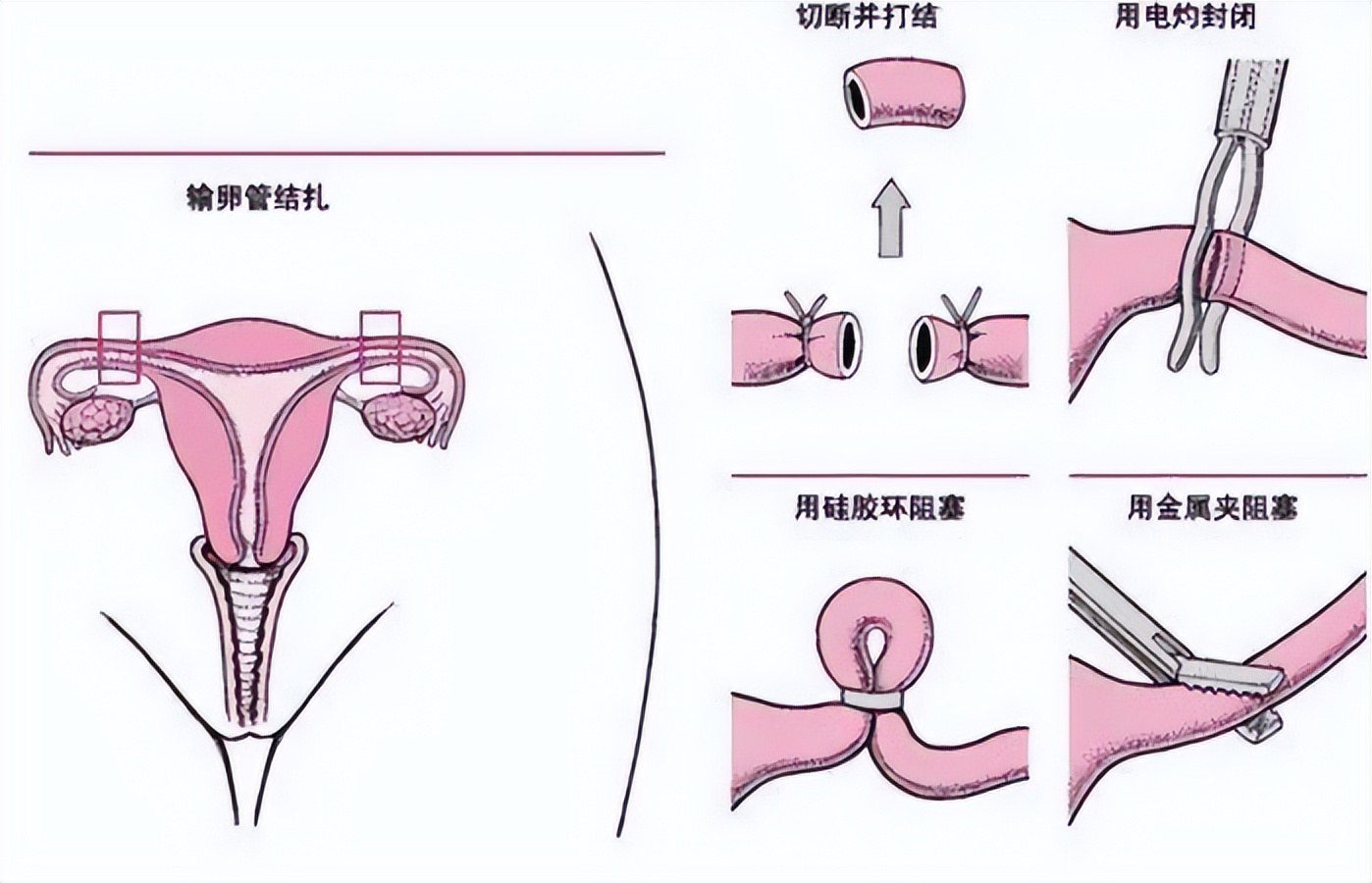 男性结扎了对男性有没有影响,男生做结扎对男性有影响么