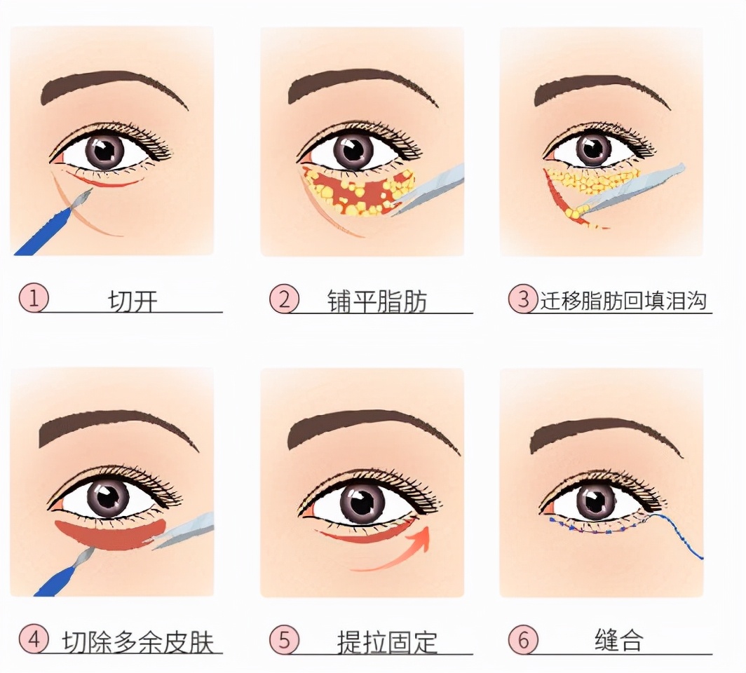 眼袋大怎么办如何解决快又好,眼袋大很显老小妙招