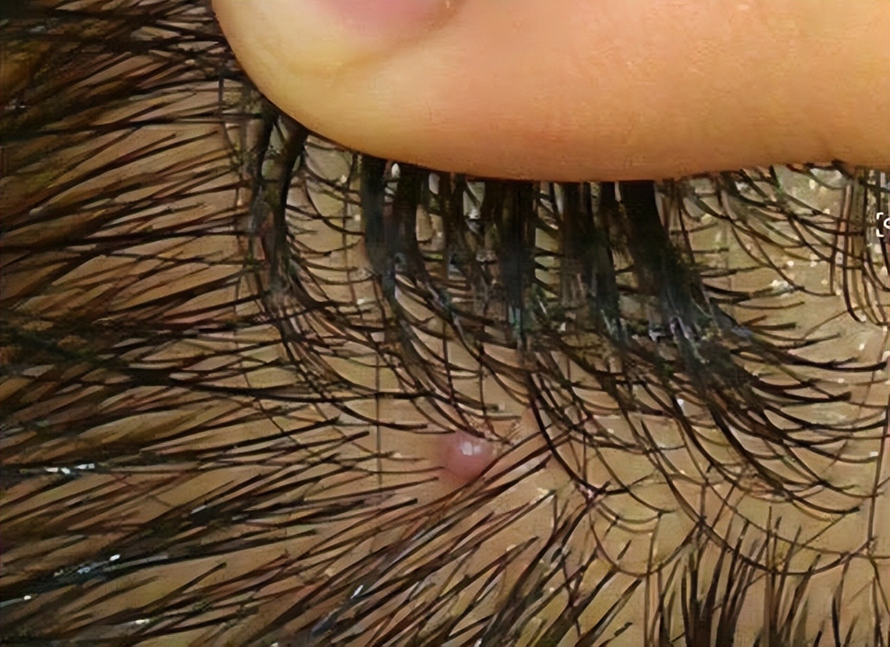 头皮老是长疙瘩和脓包是怎么了,头皮老是长疙瘩有脓包是什么原因