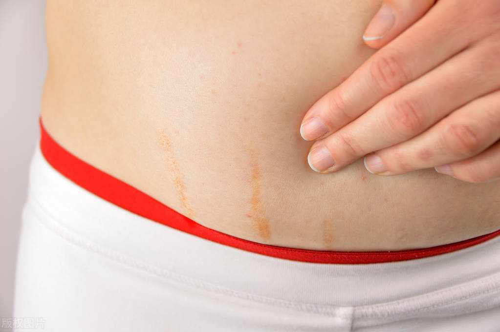 妊娠纹去除的药店小药膏,妊娠纹去除的好方法