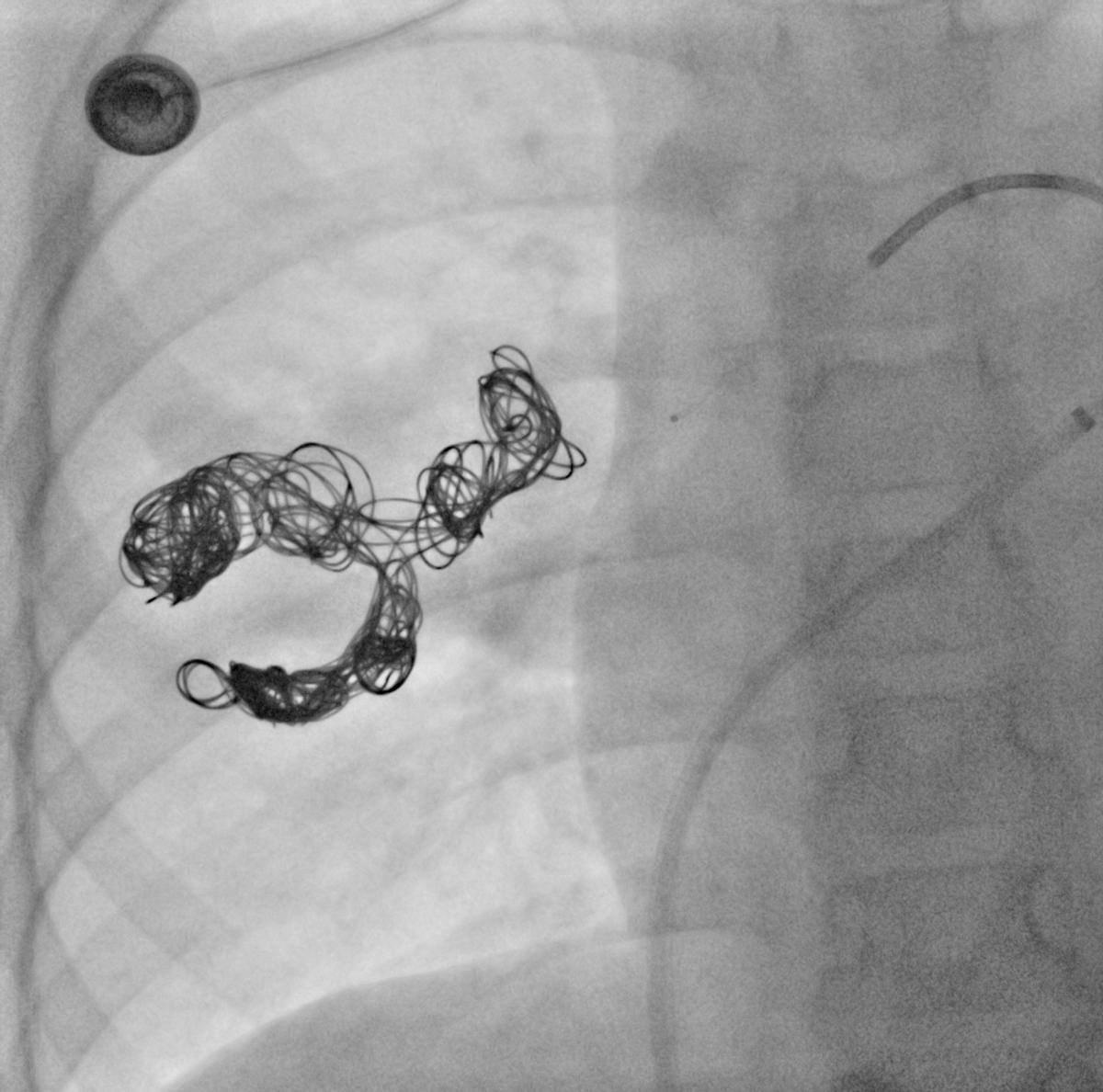 儿童遗传性毛细血管扩张会自愈么,遗传性出血性毛细血管扩张ct表现
