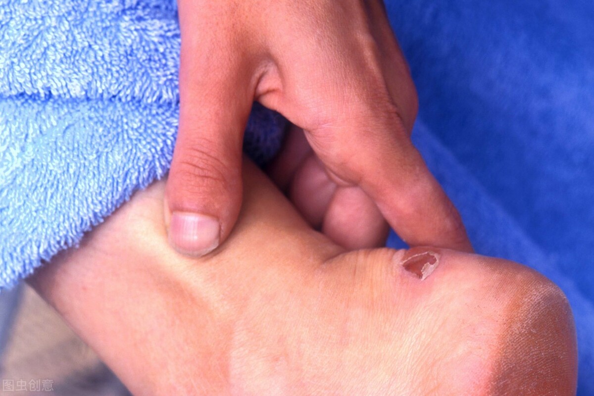 跑步鞋磨脚后跟处理4种方法,跑步磨脚是鞋子原因还是袜子原因