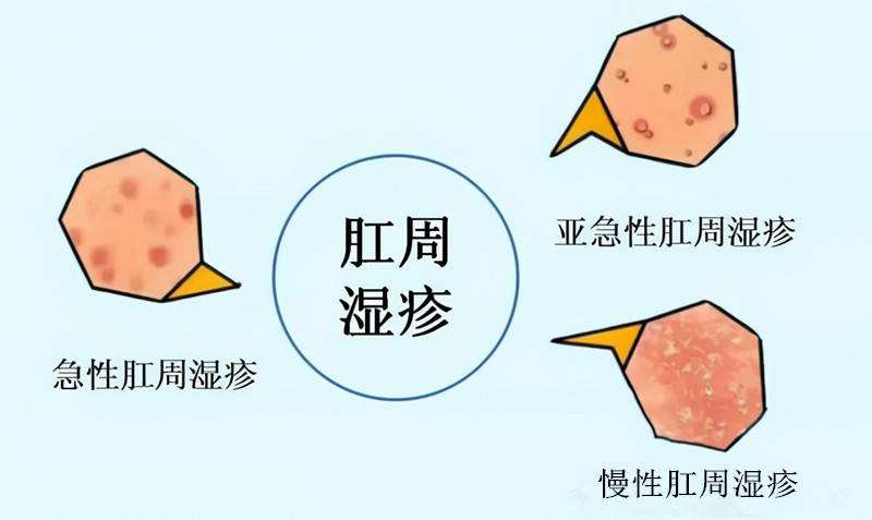 肛周湿疹瘙痒可以用炉甘石吗,肛周瘙痒怎么判断是痔疮还是湿疹