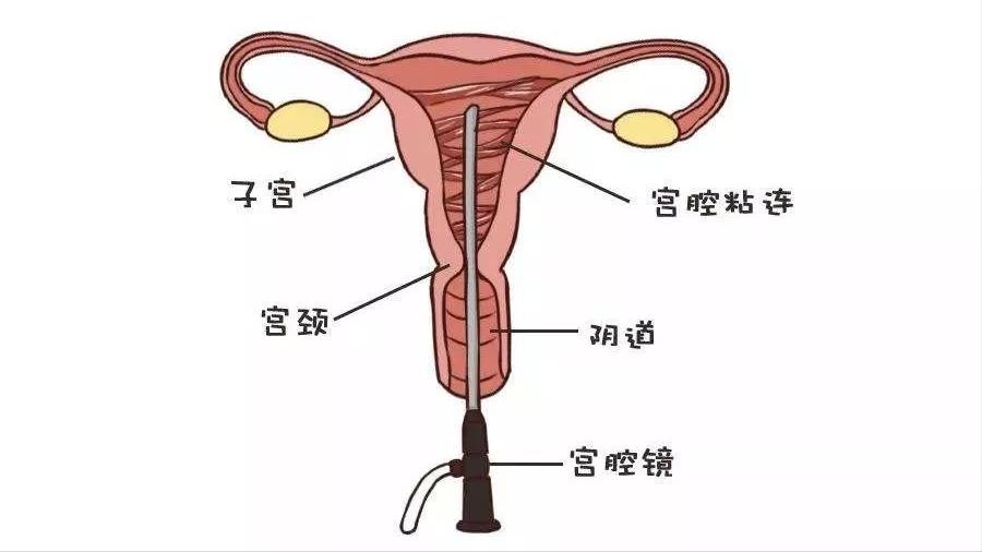 闭经是不是指一直没来,为何女性容易出现月经不调的问题