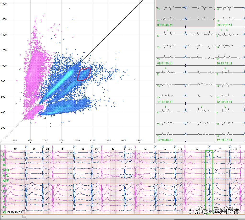 房早室早区别,房早室早房颤